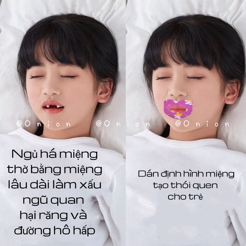 Hộp 30 miếng dán chống thở bằng miệng há miệng khi ngủ
