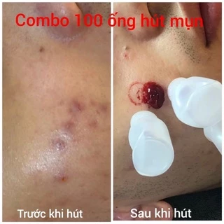 Combo 50 lọ nhựa dày dùng hút máu bầm.