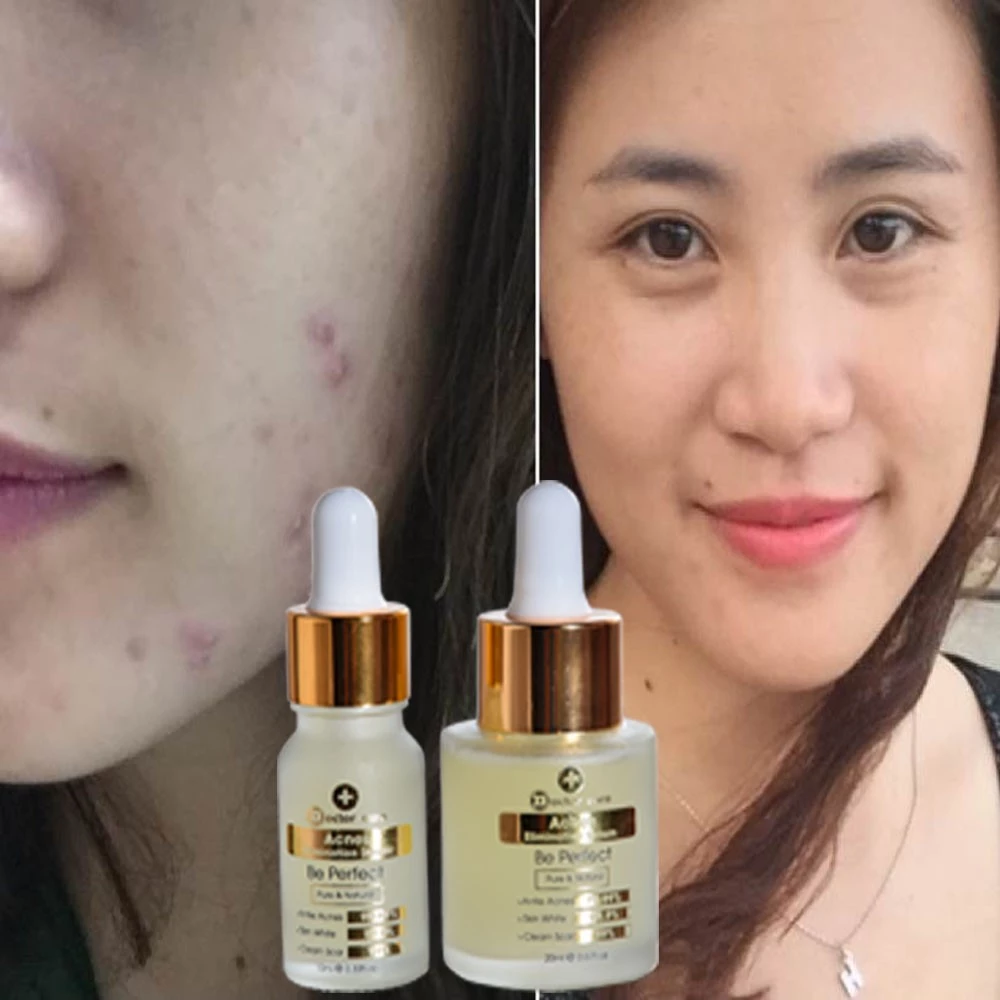 Serum TRI MUN ẩn, mụn thâm, mụn đầu đen  Doctor Care