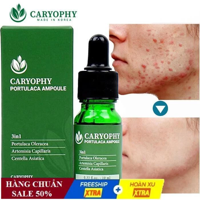 Serum ngăn ngừa mụn và thâm Caryophy Chính Hãng - Serum Mụn Ngăn Ngừa Mụn Ẩn,Mụn Đầu Đen