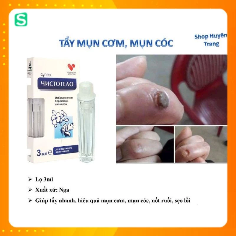 Gel Dvelinil TẨY MỤN CƠM, MỤN CÓC, NỐT RUỒI, THỊT THỪA của Nga (hiệu quả sau 3 - 5 ngày)