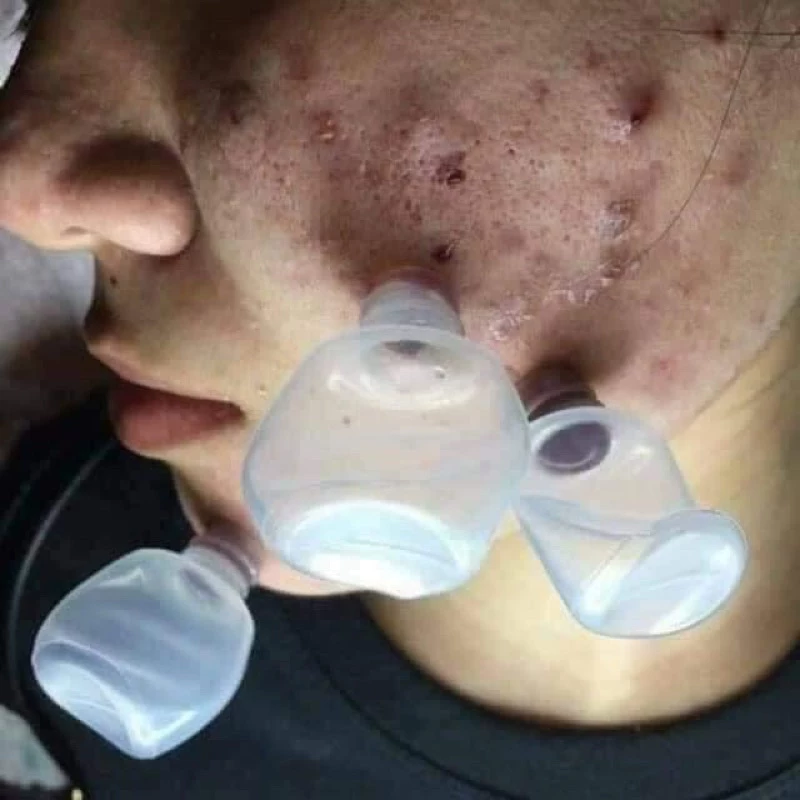combo 1000 ống hút máu bầm