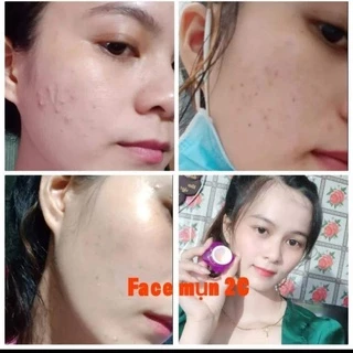 FACE MỤN 2C(mua 10tặng 1)