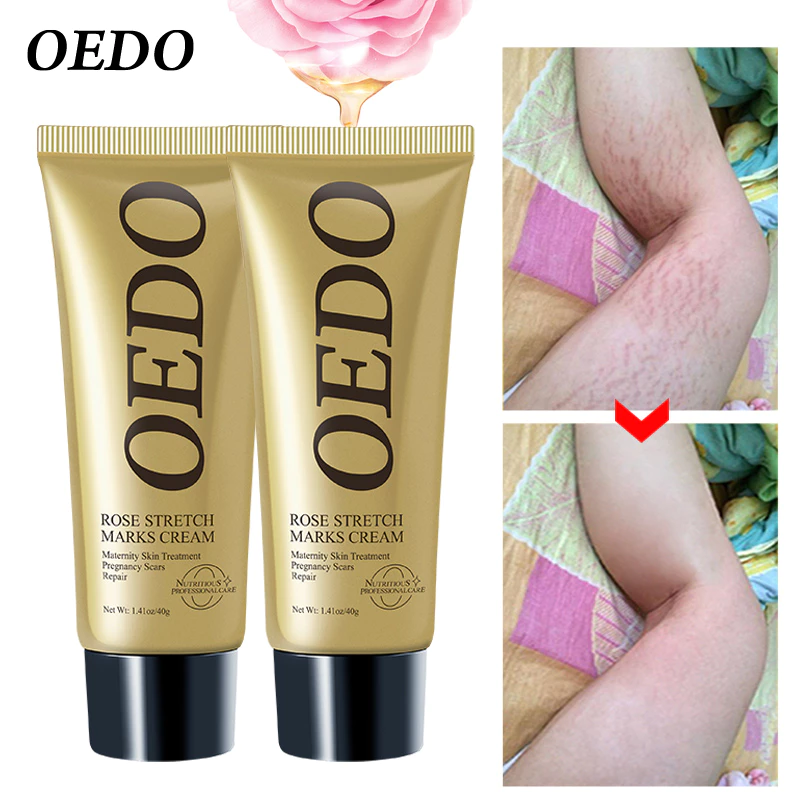 Set 2 kem xóa vết rạn OEDO tinh chất hoa hồng cho phụ nữ mang thai