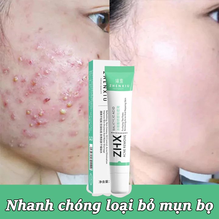 Kem chấm mụn Kem trị mụn Nhanh chóng loại bỏ mụn bọ 20g trợ giảm mụn kiểm soát dầu thu nhỏ lỗ chân lông