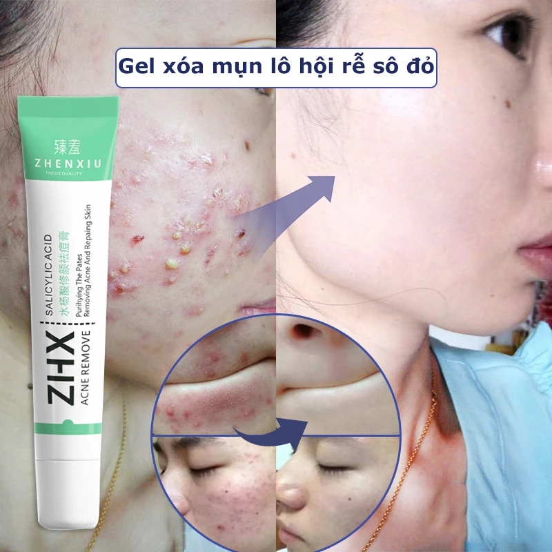 ⭐CHÍNH HÃNG⭐Gel Giảm Mụn Kem làm đẹp Giảm Mụn Kem Mụn nhanh chóng loại bỏ mụn bọc 20g Gel rửa mặt hiệu lực kem bôi mụn, phục hồi vết tích mụn và mụn, làm mờ thâm mụn