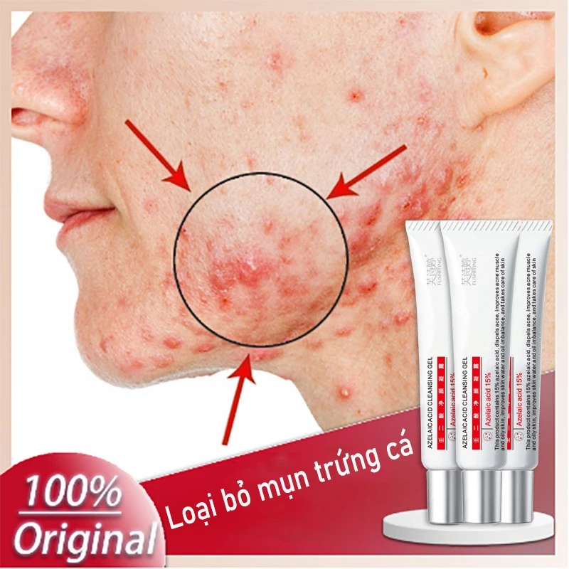 ❤️100% Chính Hãng❤️Kem mụn Gel mụn Azelaic 15% thuốc mụn trứng 15g Loại bỏ vết mụn trứng cá Kháng khuẩn chống viêm Phiên bản nâng cấp