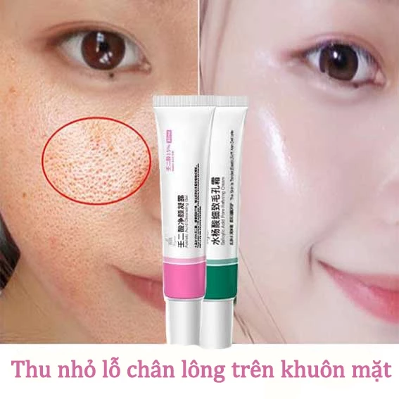 Kem thâm mụn Kem giảm mụn Gel mụn 30g Giảm mụn nhanh chóng và hiệu quả Làm sáng màu da Dưỡng ẩm chăm sóc da mụn