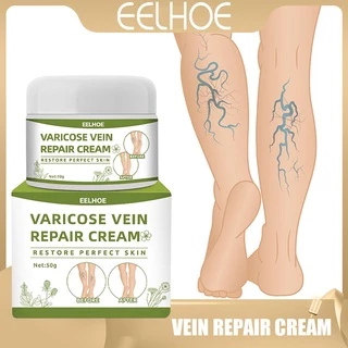 【Mua 2 tặng 1】Kem Eelhoe Làm Dịu Vết Tĩnh Mạch Giảm Đau Ngăn Ngừa Veins Giảm Giãn Tĩnh Mạch Dưỡng Ẩm Cải Thiện Tình Trạng Giãn Tĩnh Mạch Chân Hiệu Quả