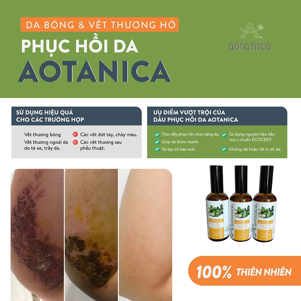 Dầu phục hồi da bỏng & vết thương hở Aotanica 90ml