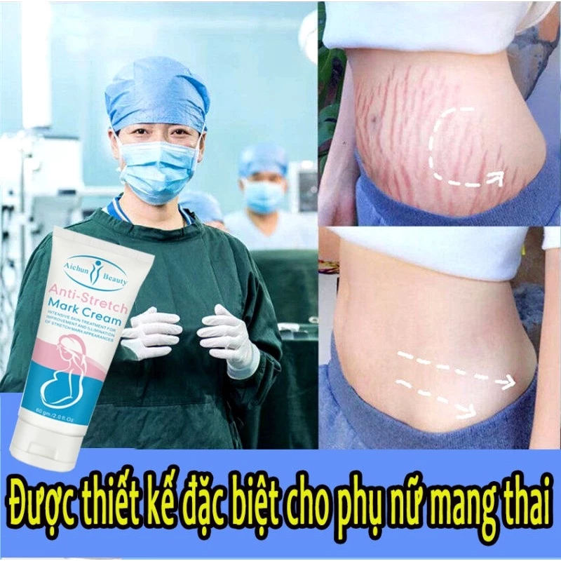 (Xóa rạn da nhanh chóng trong 7 ngày) Kem xoá rạn da sau sinh, làm mờ vết thâm, sáng đều màu da, cải thiện sẹo lâu năm, kem phục hồi săn chắc, xóa rạn da do béo phì 60g