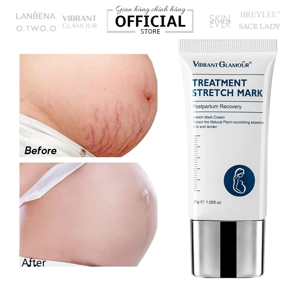 Kem làm mờ sẹo, rạn da Vibrant Glamour Treatment Stretch Mark