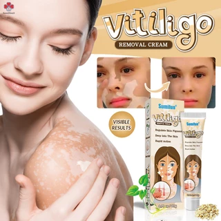 Beautyone vitiligo removal cream kem làm sạch bạch biến chăm sóc da chăm sóc da kem dưỡng da-làm giảm các đốm trắng trên da đều màu da