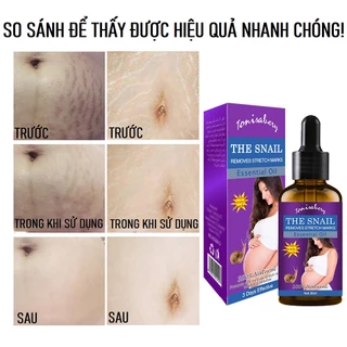 Tinh Chất Ốc Sên Hỗ Trợ Giảm Sẹo, Làm Mờ Vết Rạn Da Sau Sinh THE SNAIL REMOVES STRECH MARKS