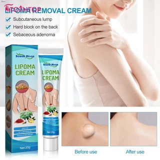 South Moon 20g Kem Loại Bỏ lipoma lipolysis chất béo giảm cục thạch cao da sưng Thuốc mỡ kem loại bỏ chất béo 20g [hàng đầu]