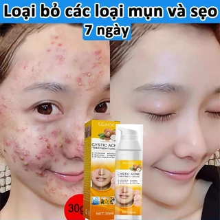 Kem chấm mụn hiệu quả hết mụn siêu tốc ngừa sẹo thâm dành cho da dầu nhờn，Kem giảm mụn chuyên sâu /30ml