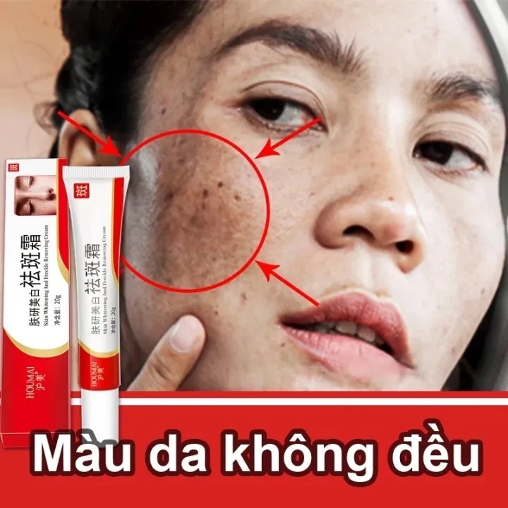 Kem xóa tàn Kem diệt tàn nhang (Loại bỏ tàn nhang nhanh chóng) kem làm trắng da hiệu quả kem ngừa nám Chuyên sâu