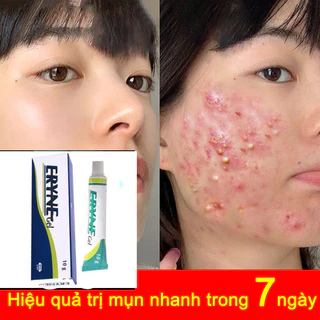 Kem Mụn nhanh chóng loại bỏ mụn bọc, kem bôi mụn, phục hồi vết tích mụn và mụn, làm mờ thâm mụn hiệu quả nhanh