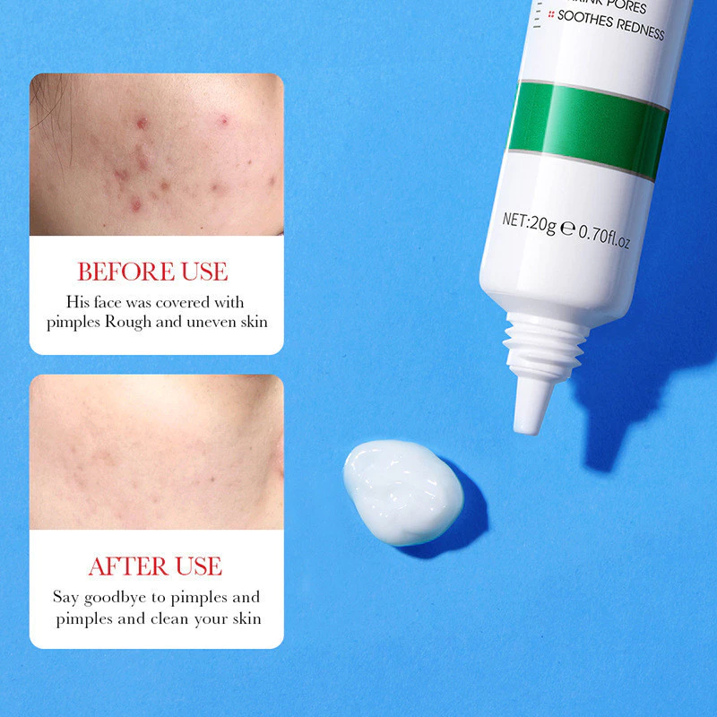 Bioaoua Salicylic Acid Acne Cream Dưỡng ẩm, Giảm sẹo mụn, Kem thu nhỏ lỗ chân lông, Kem Hỗ trợ giảm mụn, Chăm sóc da