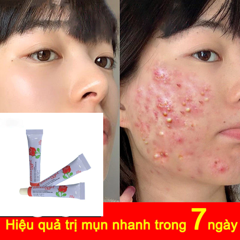 Kem mụn giúp nhanh chóng loại bỏ mụn bọc, kem bôi mụn, phục hồi vết tích mụn và mụn, làm mờ thâm mụn hiệu quả nhanh