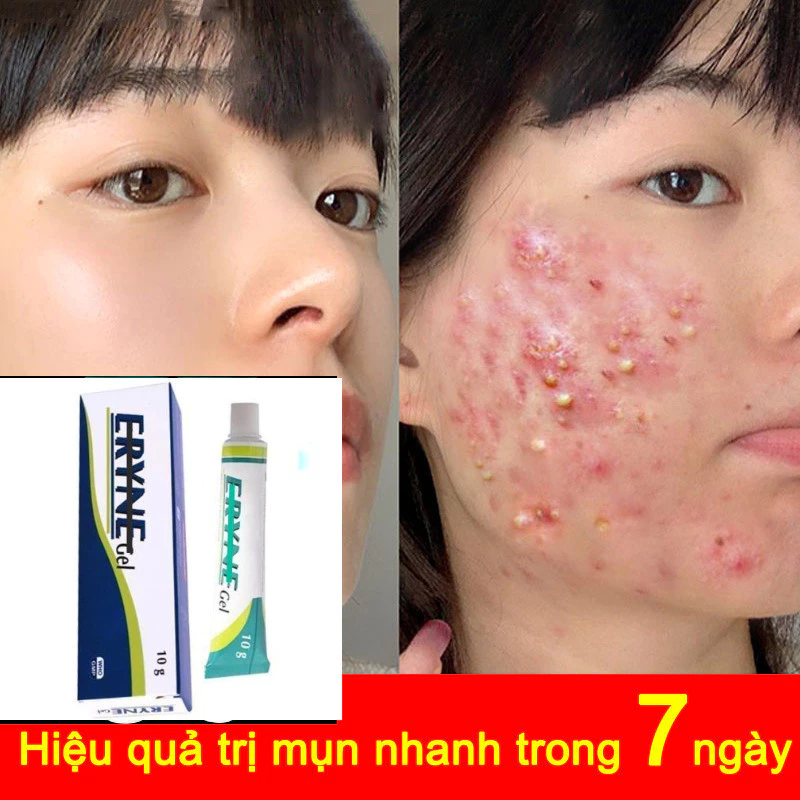 Kem bôi giảm mụn nhanh chóng loại bỏ mụn, phục hồi vết tích mụn và mụn, làm mờ thâm mụn hiệu quả nhanh