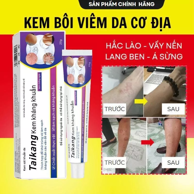 Kem chống ngứa tác dụng nhanh Kem chống ngứa ốc sên Kem chống nấm Kem chống ngứa Viêm da dị ứng