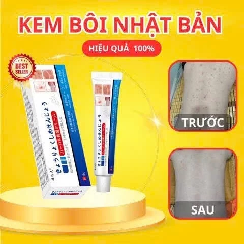 [CHÍNH HÃNG] KEM VIÊM DA NHẬT BẢN-nấm ngứa, lang ben, hắc lào, viêm da cơ địa.