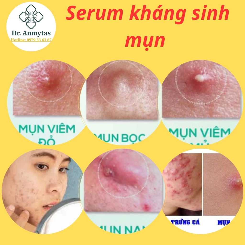 Serum Acnes Kháng Sinh Mụn Cao Cấp.