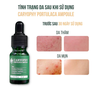 Serum cho da mụn thâm Caryophy xóa sạch mụn trứng cá, mụn bọc, sưng đỏ đầu đen 10ml -Khani