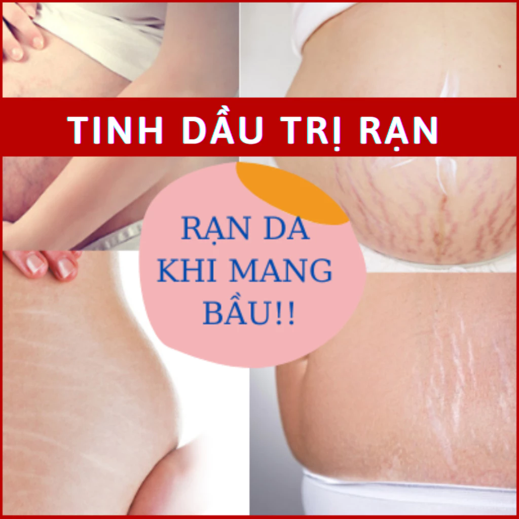 Rạn da 🎁Mom Việt🎁 Tinh dầu rạn da | Kem trị rạn da cho bà bầu | Tinh dầu trị rạn da | Rạn da sau sinh