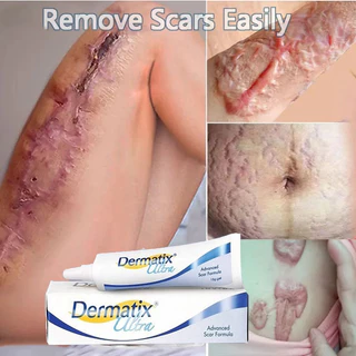 [HCM]Kem  sẹo Dermatix Ultra Kem làm mờ rạn da, kem tái tạo da hiệu quả cho bà bầu Anti-stretch Marks Cream - mờ sẹo, gi