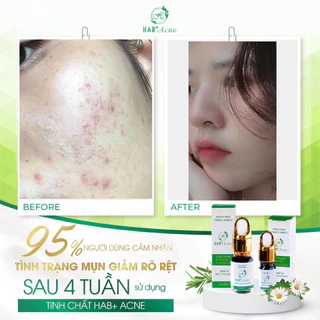 Hab+acne tinh chất thảo mộc thiên nhiên dưỡng da bị mụn