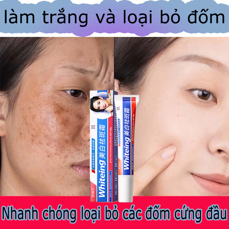 Tinh chất làm trắng sạch tàn nhang 20g Kem trắng da và xóa tàn nhang, Hiệu quả làm mờ thâm nám tàn nhan, Kem nám tàn n