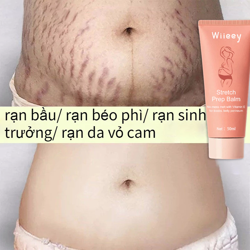 kem rạn da Kem xóa nhăn Kem loại bỏ sẹo 50g làm mờ vết rạn sau sinh làm săn chắc da cho bà bầu làm hết mờ sẹo làm trắng