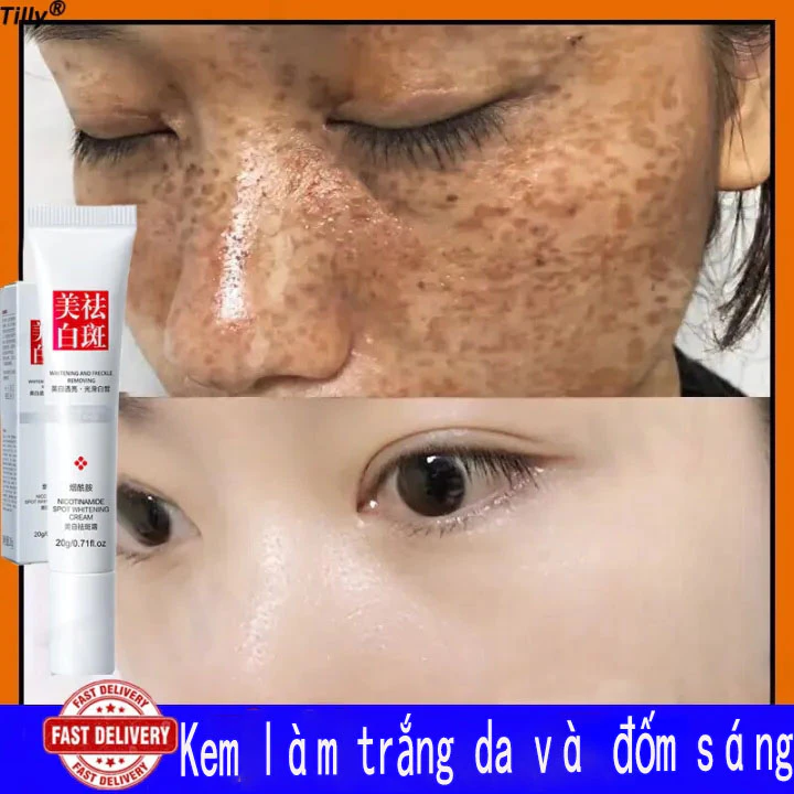 Tinh chất làm trắng sạch tàn nhang 20g Kem trắng da và xóa tàn nhang, Hiệu quả làm mờ thâm nám tàn nhan, Kem nám tàn n