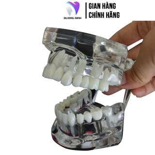 Mẫu hàm tư vấn nha khoa cắm implant, sâu răng ST05