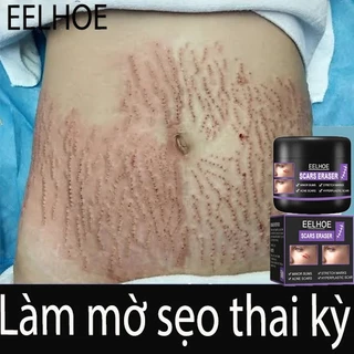 Kem Làm Mờ Rạn Da Kem Tri Sẹo Làm Mờ Sẹo, Mụn Trứng Cá,Kiểm Soát Sẹo Mụn Loại Bỏ Sẹo Phục Hồi Da Mặt Tai Chân Sẹo Cơ Thể