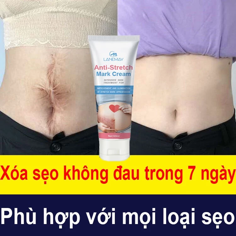 Kem sửa chữa vết rạn da 60g Chăm sóc sau sinh đặc biệt để loại bỏ sẹo khi mang thai, săn chắc khôi phục hư tổn