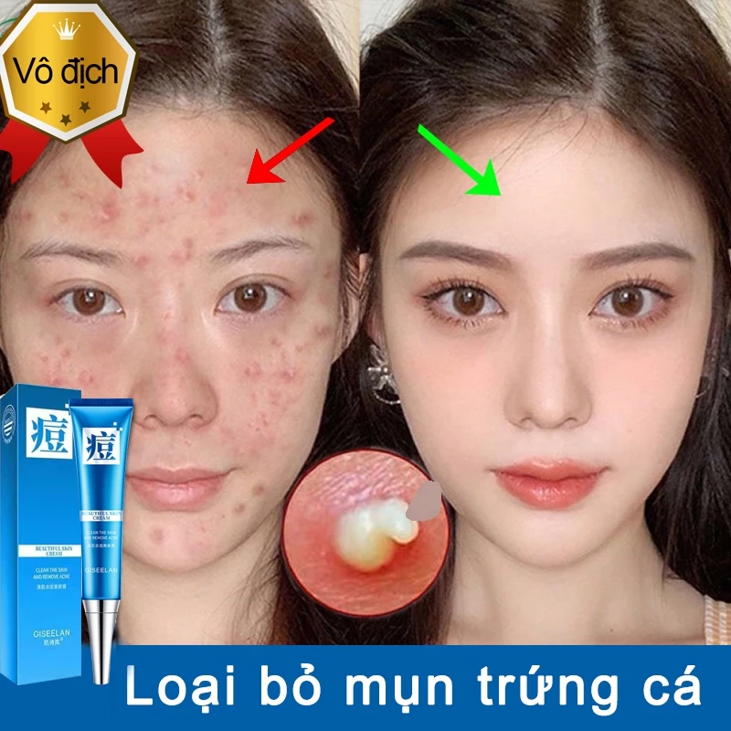 Kem loại bỏ mụn nhanh 20g chóng xoá mụn hiệu quả làm nhạt vết mụn giảm mụn trứng cá kiểm soát dầu cải thiện lỗ chân