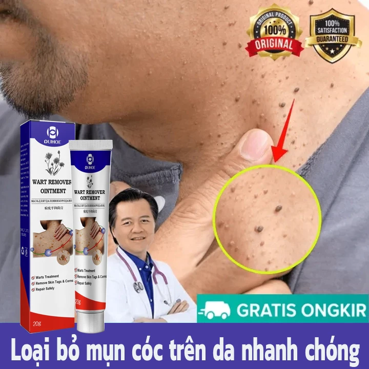 Wart Remoal Cream Kem Mụn Cóc Kem Tẩy nốt ruồi 20g