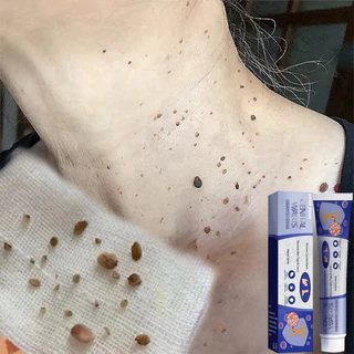 South Moon Wart Removal Cream Kem mụn cóc 20g loại bỏ  mụn cóc tẩy nốt ruồi mụn cóc phục hồi gel làm mờ sẹo