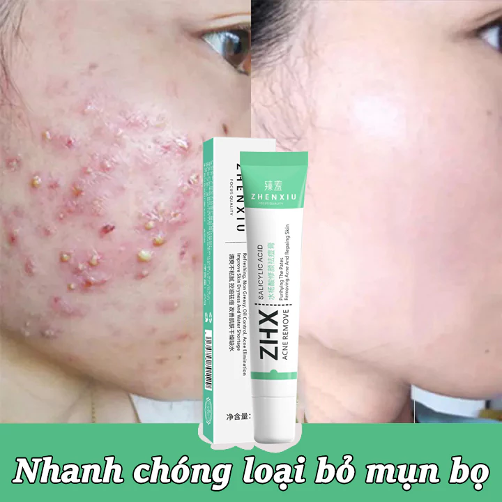 kem chấm mụn kem giảm mụn gel chấm mụn,giảm mụn kiểm soát dầu thu nhỏ lỗ chân lông,dưỡng ẩm hiệu quả sử dụng tiện lợi