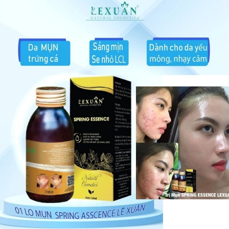 [Chính Hãng] Ngừa Mụn Thảo Dược Đông Y Lê Xuân - 130ml Sạch Mụn Trứng Cá Mụn Ẩn Mụn Đầu Đen Mụn Lưng