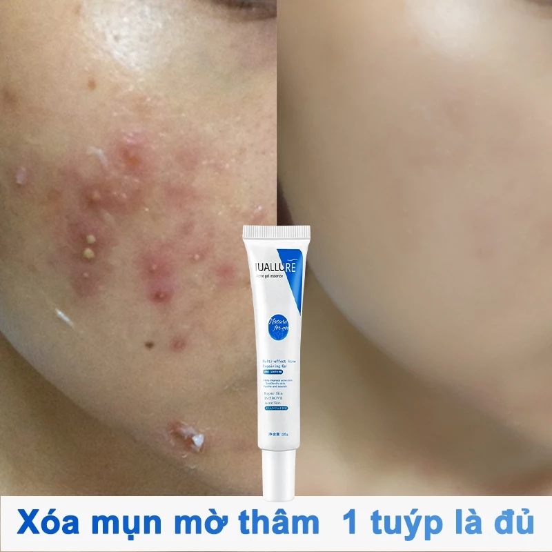 Gel giảm mụn kem chấm mụn gel thâm mụn 20g Giảm mụn nhanh chóng và hiệu quả Làm sáng màu da Dưỡng ẩm chăm sóc da mụn