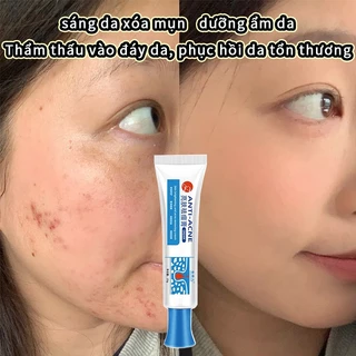 Giảm mụn Kem Giảm Mụn Loại bỏ mụn trứng cá loại bỏ vết mụn làm mờ vết thâm se khít lỗ chân lông làm trắng da