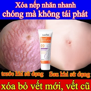 ⭐SADOER⭐ Kem rạn da(Xóa rạn da nhanh chóng trong 7 ngày)Kem xoá rạn da sau sinh làm mờ vết thâm tăng độ đàn hồi cho da l