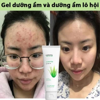 Gel lô hội loại bỏ mụn trứng cá, kiểm soát dầu, dưỡng ẩm, xóa sẹo và phục hồi vết mụn, đồng thời làm dịu da.60g