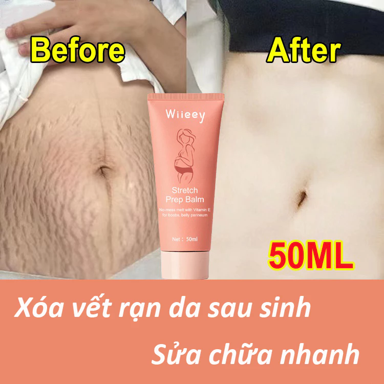 Vitamin E kem rạn da kem xóa nhăn kem phục hồi sau sinh 50ml dưỡng ẩm sâu phục hồi độ đàn hồi của da thành phần nhẹ