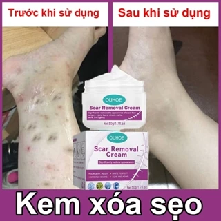 kem xóa sẹo loại bỏ hiệu quả các vết sẹo cũ sẹo sẹo phẫu thuật, phục hồi và làm sáng các vết rạn da khi mang thai