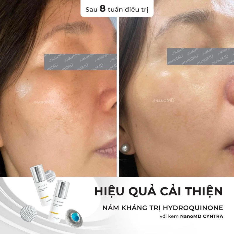 KEM GIẢM NÁM, TÀN NHANG CYNTRA 20ml